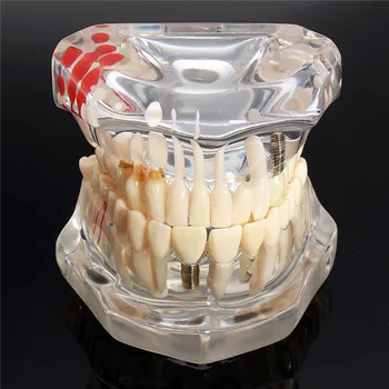 Модель зубного имплантата Модель зубов Зубной стоматолог для стоматологических заболеваний Учебное пособие